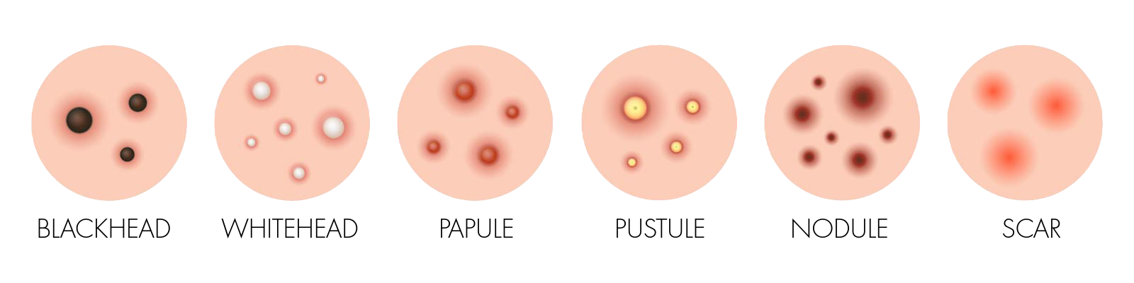 ACNE TYPES